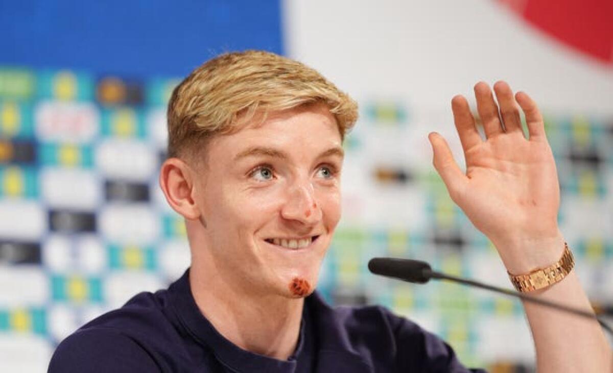 England’s Anthony Gordon smiles as he explains his bike accident during a press conference
